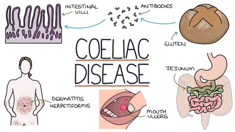 coeliac disease dating